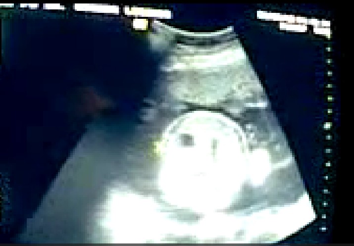 Ultrasound